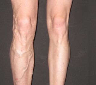 A varicosis gyorsan halad