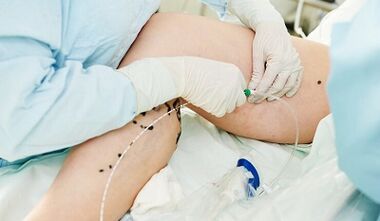 A varikózis vénák kezelésére szolgáló módszerek a nőknél a lábakon