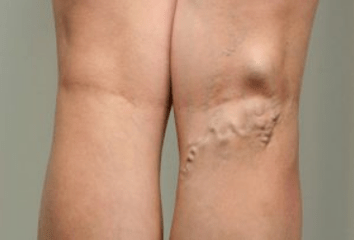 A varikózus vénák diagnosztizálása terhes nőknél