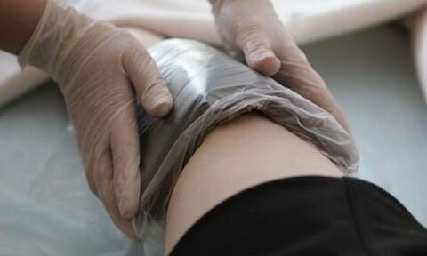 visszér kezelése borogatással