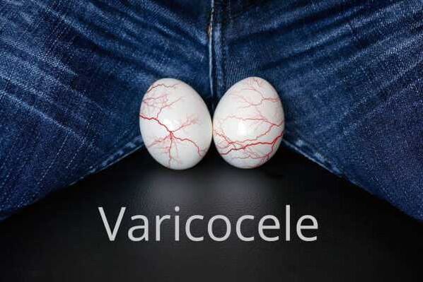 Varicocele - a spermiumzsinór vénáinak kitágulása